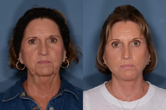 Facelift before and after