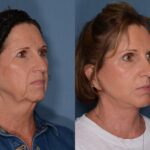 Face Lift before and after