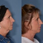 Face Lift before and after
