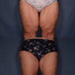Before and After Thigh Lift with associated liposuction (6 months post op)