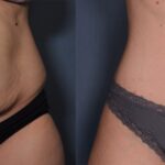 Tummy Tuck with Waistline Liposuction Before and After