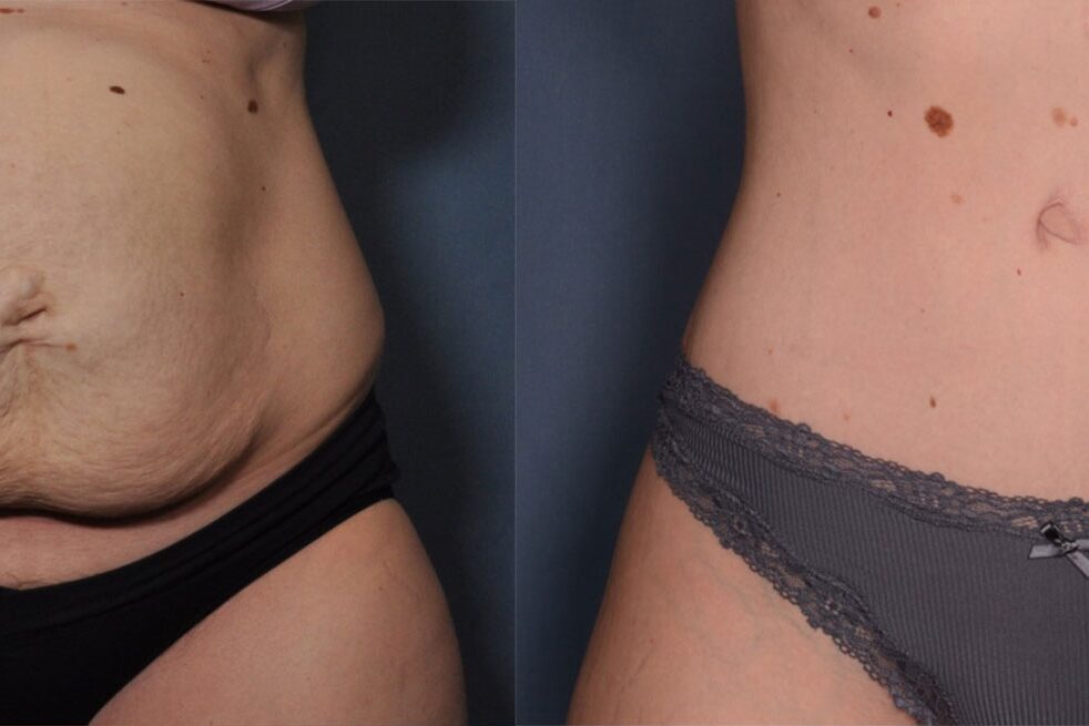 Tummy Tuck with Waistline Liposuction Before and After