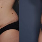 Tummy Tuck with Waistline Liposuction Before and After