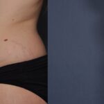 Tummy Tuck with Waistline Liposuction Before and After