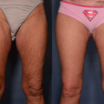 Thigh Lift with Liposuction before and after