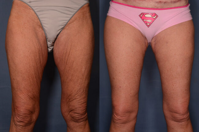 Thigh Lift with Liposuction before and after