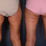 Thigh Lift with Liposuction before and after