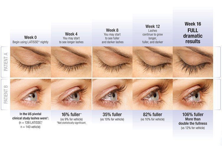 latisse-before-after Latisse Before and After Results