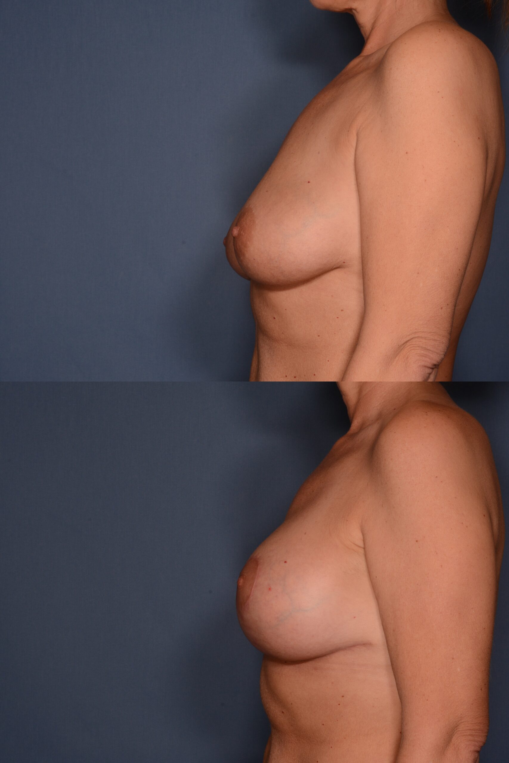 Mastopexy with Augmentation- Before and After