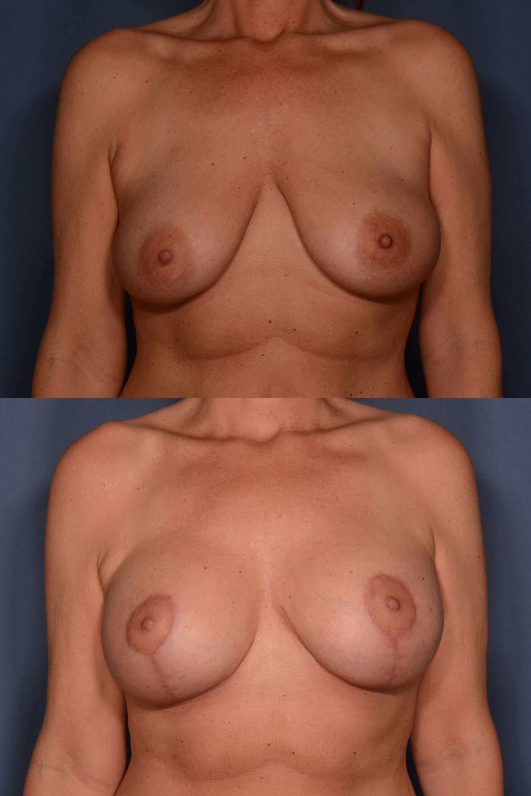 Mastopexy with Augmentation- Before and After