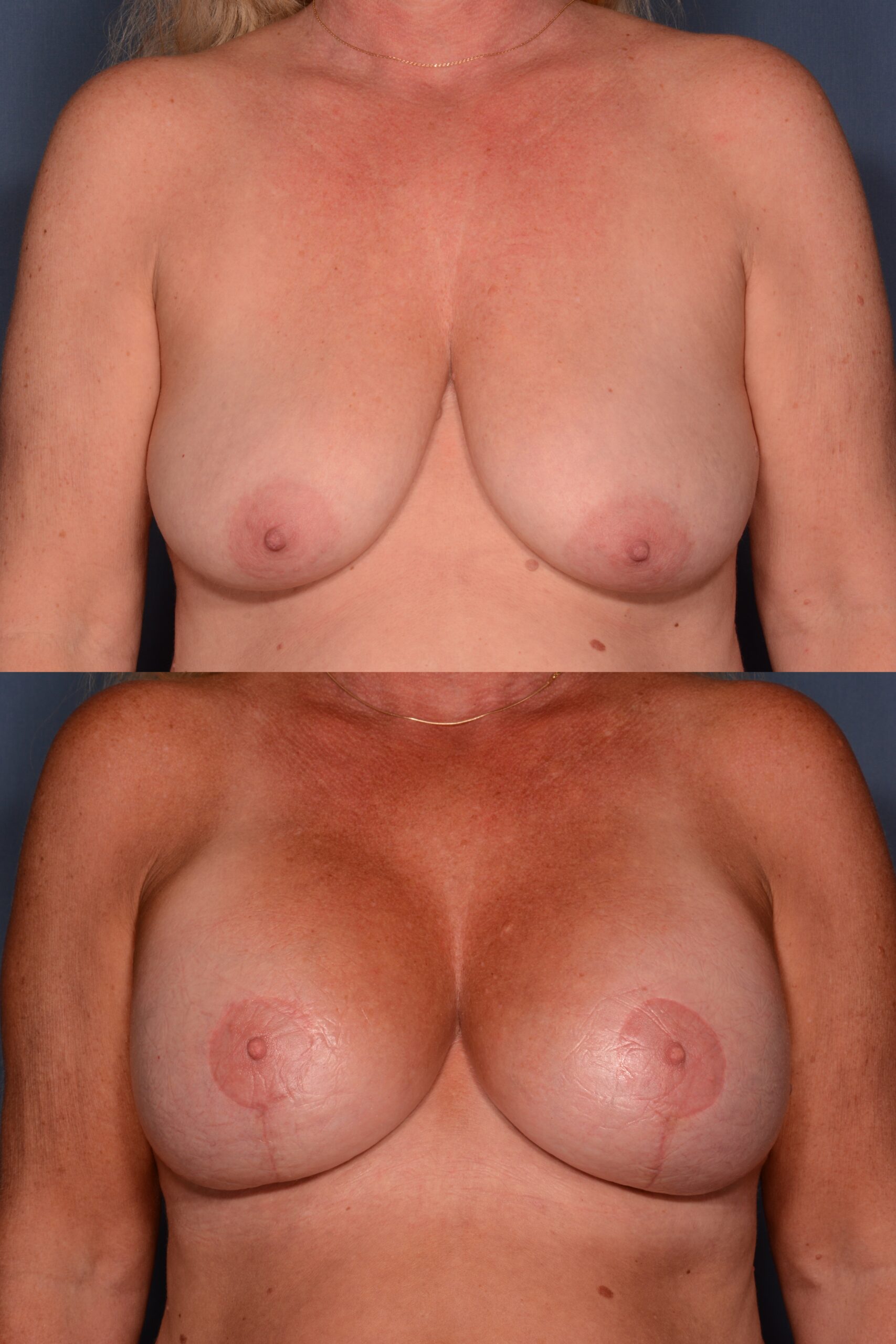 Mastopexy with Augmentation- Before and After