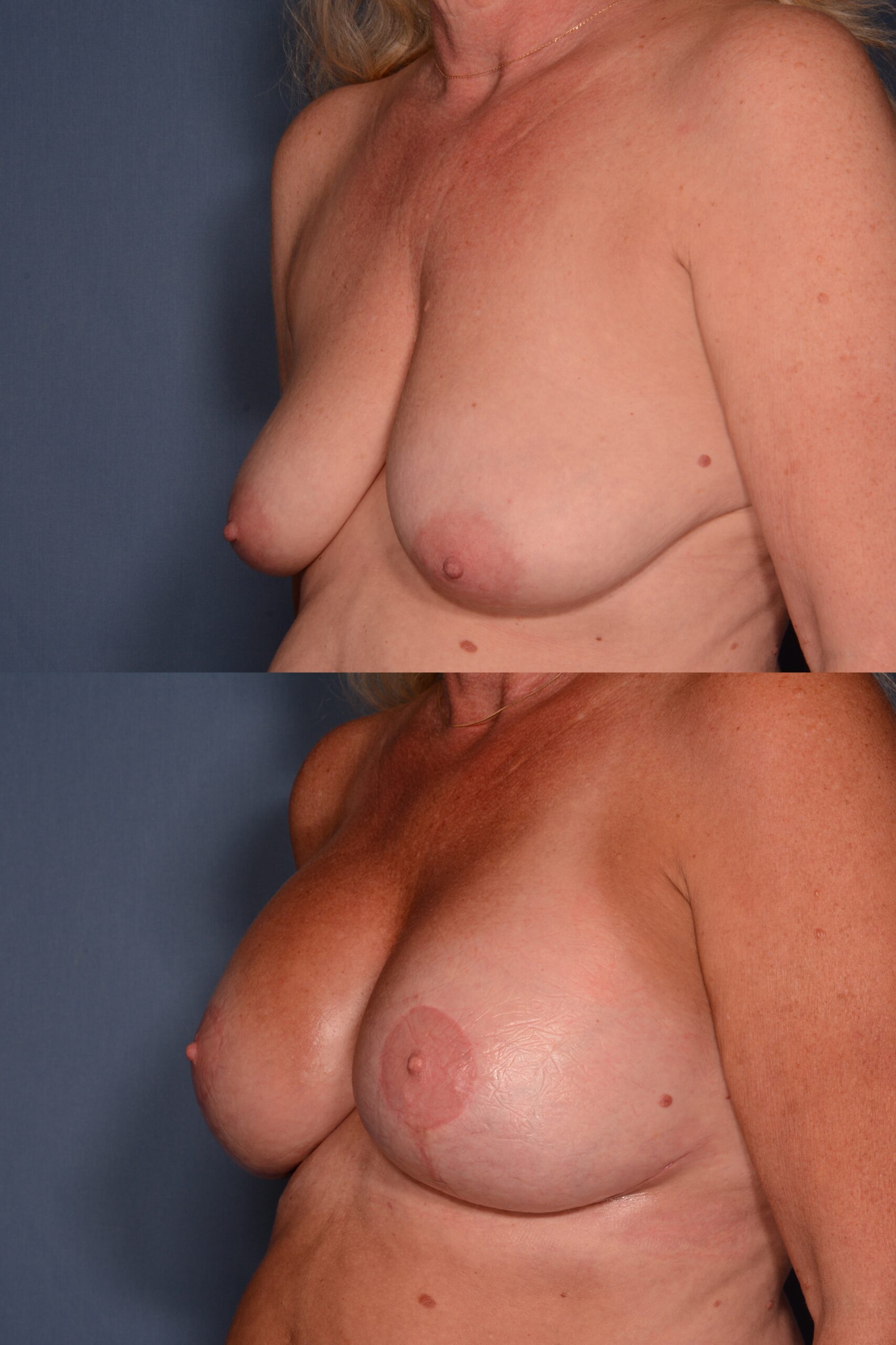 Mastopexy with Augmentation- Before and After