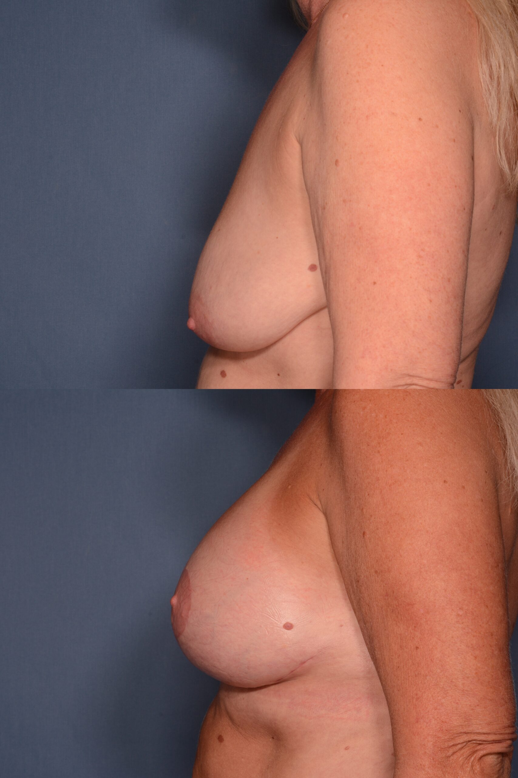 Mastopexy with Augmentation- Before and After