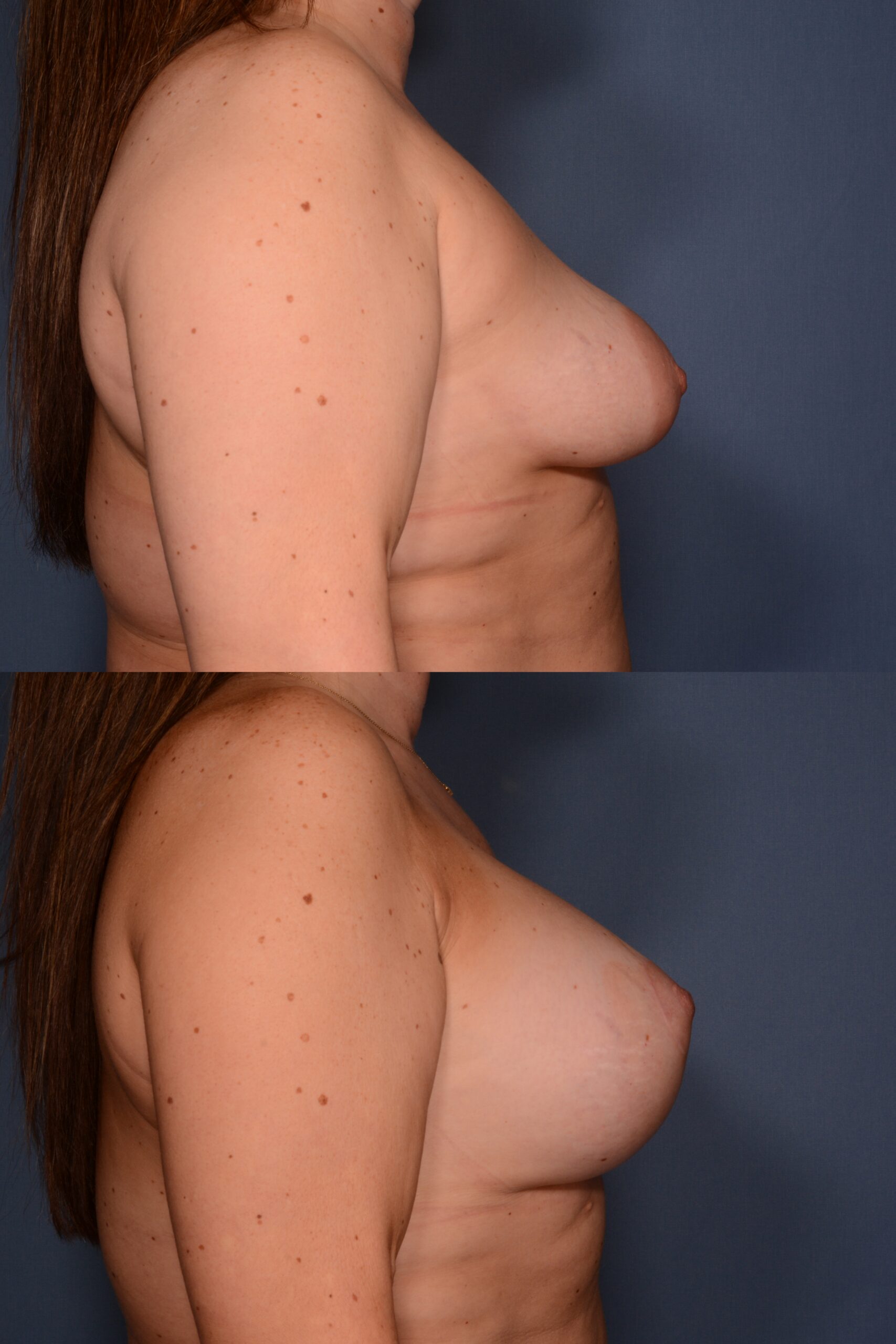 Mastopexy with Augmentation- Before and After